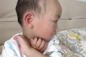 求支招，宝宝脸上手上全部是红疙瘩，痛痒难耐该买什么药膏擦视频封面