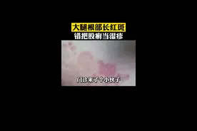 大腿根部长红斑，瘙痒难忍，#股癣，#湿疹 要分清，可别用错了#科普 视频封面