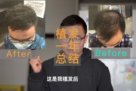 土耳其植发｜体验总结和常见植发问题答复，满满的干货视频封面