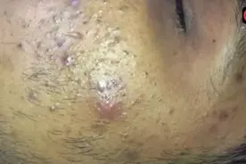 养了一脸好黑头 #强迫症看了很享受 #消除鼻头粉刺的正确有效方法