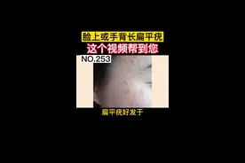  #扁平疣 十分令人困扰，影响美观，如何科学处理？ #皮肤  #科普  #生活 