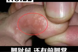 脚底出现水泡特别痒，教你一招简单处理#皮肤 #脚藓 视频封面