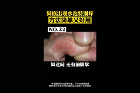脚底出现水泡特别痒，教你一招简单处理#皮肤 #脚藓 视频封面
