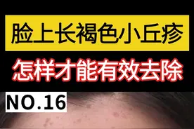 很多年轻人的脸上长褐色小丘疹，影响颜值，扁平疣怎样才能有效去除#皮肤 #医学科普 #扁平疣 视频封面