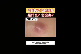 屁股上长了红肿疙瘩是什么？怎么办？#皮肤 #火疖子 