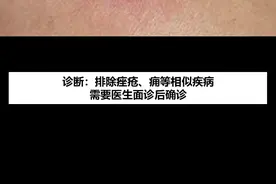 屁股上长了红肿疙瘩是什么？怎么办？#皮肤 #火疖子 视频封面