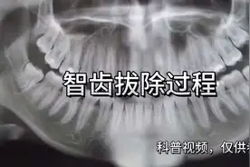 专业视频，非喜勿入，智齿拔除过程。#拔智齿 #解压视频 #拔牙视频封面