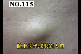 脸上长半月形的大包，#表皮样囊肿 怎么办？#囊肿 #皮脂腺囊肿 视频封面