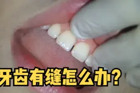 当门牙牙缝大时，你选择正畸、贴面还是怎么处理视频封面