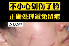 脸不小心被指甲划伤了，没处理好，容易留疤，非常影响颜值，所以，第一时间正确处理很关键#疤痕 #医学科普 视频封面