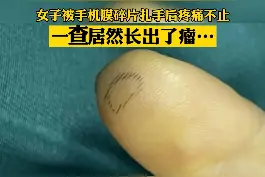 近日，杭州 #女子被手机膜碎片扎手后长出瘤。看完想提醒自己：再省也别省手机膜