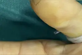 近日，杭州 #女子被手机膜碎片扎手后长出瘤。看完想提醒自己：再省也别省手机膜