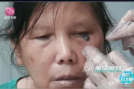 女子脸上长黑色肿块，老伴儿买药膏给她涂，竟然发展成癌症？#我的白大褂 @美容皮肤于波教授 #深圳卫视  视频封面