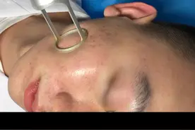 三甲医院二氧化碳点阵激光#皮肤 视频封面