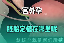 直播回放：宫外孕，胚胎定植在哪里呢？ #医学生 #医学生 #宫外孕