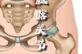 骶髂关节炎 骶髂关节的不适通常较难直接治疗，当疼痛难忍严重影响生活学习的情况下可以试试介入疗法。#骶髂关节 #疼痛治疗 #吴斌医生 #硬核健康科普行动 #听医生一句劝视频封面