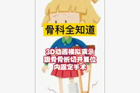 骨科全知道：3D动画模拟演示跟骨骨折切开复位内固定手术 跟骨骨折手术是如何进行的？带您沉浸式观摩……#骨折 #骨折手术 #跟骨骨折 #硬核健康科普行动 #医疗健康创作训练营