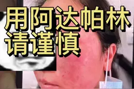 还是小心的好，避免出现副作用！ #拯救痘痘肌 #阿达帕林 #烂脸修护