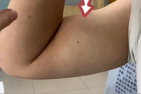 肱二头肌断裂，大力水手征 #医学科普 #专业的事交给专业的人 #帮助患者摆脱困扰 #肱二头肌长头腱断裂 #耿硕说骨视频封面