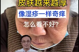头面部手上奇痒，多处求诊无效，太难受了！ #医学科普 #硬核健康科普行动 #新年快乐 #紫外光视频封面
