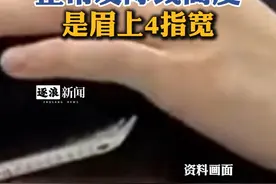 正常发际线高度是眉上4指宽视频封面