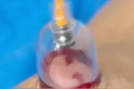 #女子坚信拔罐放血能养生每周放血200ml，慢性失血导致重度贫血视频封面