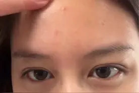 我勒个痘！这难缠的额头痘居然被我这简单一招搞走了？#拯救痘痘肌 #痘痘肌 #告别痘痘肌 #额头长痘 #额头祛痘视频封面