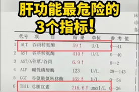 肝功能重点看这3个指标！ 1.转氨酶：谷丙转氨酶和谷草转氨酶的升高都表示转氨酶升高，随着转氨酶越高，肝脏的炎症可能就越严重。 2.胆红素：胆红素越高，肝脏的损害也是越大的。可能会出现黄疸等表现，特别是出现了胆红素升高，转氨酶轻微升高或降低的时候，这就是胆酶分离的情况，也叫做急性肝衰竭！很危险！ 3.白蛋白：白蛋白低于30，可能会出现腹水！ #科普 #肝功能 #乙肝 #肝病 #山东