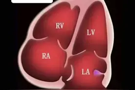 华法林嵴，又称香豆素嵴或左心房嵴（Coumadin ridge or warfarin ridge or left atrial ridge ）视频封面