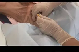 #输液港 适用于需要长期输液或化疗的患者。输液港感染风险低，能减少穿刺血管的次数，保护血管，减少药物外渗的机会。 维护简单，治疗间歇期4周维护一次即可。使用期限长，正常情况下，护理较好的输液港能使用10年以上，甚至终身。当输液港到期或者患者治疗结束，只需切开皮肤，将输液港取出即可。视频封面