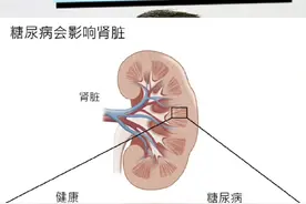 血糖高，怎么选牛奶？ #硬核健康科普行动 #糖尿病 #守护血糖健康指南 #高血糖 #糖尿病科普视频封面