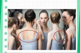 孩子后背“小翅膀”翼状肩胛#少儿体态矫正 #翼状肩胛 #运动康复