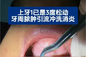 牙周脓肿，牙槽骨吸收严重，这颗牙已经3度松动了#牙周脓肿 #牙槽骨吸收 #牙齿松动 #牙周病 #口腔医生赵晶 @抖音医疗健康小助手 @健康北京 @DOU+小助手