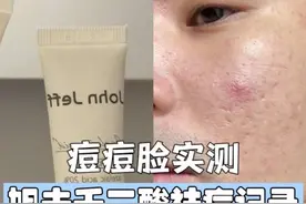 痘痘脸 实测John jeff 20%壬二酸祛痘真实效果！ #johnjeff壬二酸 #祛痘 #真实测评视频封面