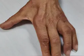尺神经受损引起小指和无名指麻木，进一步加重引起手部肌肉萎缩、无力，爪形手！#尺神经损伤 #肘管综合征视频封面