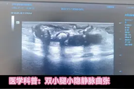 静脉石： #上热门 双下肢动静脉未见血栓，双小腿小隐静脉曲张并其内强回声团，后方伴声影，就像胆囊腔内的结石声像图；视频封面