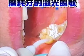 磨耗牙齿的激光脱敏 #牙齿敏感怎么办 #激光口腔诊疗 #牙齿磨耗 #激光脱敏 #口腔医生赵晶 @抖音医疗健康小助手 @健康北京 @健康中国 @DOU+小助手视频封面