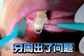 #牙周病 #牙周脓肿 #牙齿松动 #牙槽骨吸收 #口腔医生赵晶 @抖音医疗健康小助手 @健康中国 @健康北京 @DOU+小助手