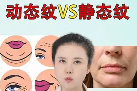 肉毒素能改善什么样的皱纹？ #鱼尾纹 #抬头纹 #肉毒素 #除皱针 #皮肤美容 @DOU+小助手