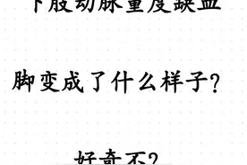 长期的动脉硬化闭塞，导致的腿缺血缺氧，最终就是皮肤发紫、疼痛、溃烂，所以一定要早期治疗。#印象最深的门诊故事 #医学科普 #动脉硬化 #糖尿病足 #帮助患者摆脱困扰 @抖音医疗健康小助手视频封面