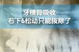 牙槽骨吸收，牙齿松动。一起读懂牙片，治牙不迷路。 #X光片 #牙片 #口腔健康 #牙齿松动 #口腔医生赵晶 @抖音医疗健康小助手 @抖音创作者中心 @抖音健康使用计划 @健康北京 @DOU+小助手视频封面