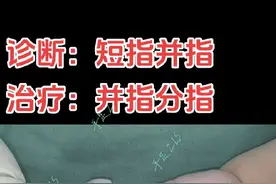 并指，短指并指 诊断：短指并指，波兰综合征？治疗：并指分指术。#短指并指 #并指 #并指分指术 #波兰综合征 #张立山手足畸形矫形