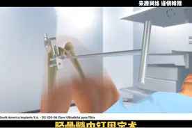 胫骨骨折髓内钉内固定手术演示。看看“铁签子”打入骨头的过程。#胫骨骨折#胫骨髓内钉#骨科手术演示视频封面