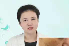 黄褐斑能不能做激光？ #黄褐斑 #淡斑 #激光 #色斑 #皮肤美容 @DOU+小助手视频封面