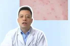 30s快速辨别艾滋患者 #艾滋病 #医学科普 #抖出健康知识宝藏