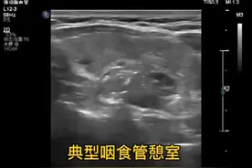 咽食管憩室超声及临床知识。#医学科普 #超声学习 #超声影像
