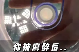 你被麻醉后，隆鼻医生在做什么？#成都隆鼻 #肋软骨隆鼻 #鼻综合视频封面