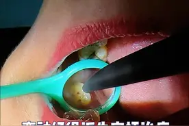 牙洞外边看较浅实则很深，离神经很近了，先垫底安抚 #牙齿健康 #安抚 #牙医日常 #补牙 #口腔医生赵晶 @DOU+小助手 @抖音医疗健康小助手 @健康中国 @健康北京视频封面