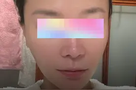拉皮术后真实恢复全过程记录～ 感谢姑娘的真实反馈～（很多视频都是由求美者本人提供，有很多不够清楚地方，还请理解）恢复得非常漂亮！大家觉得呢？#抗衰老 #拉皮 #医学科普 #医疗健康创作训练营#硬核健康科普行动视频封面