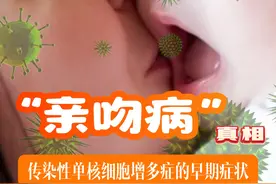 亲吻病”真相：传染性单核细胞增多症的早期症状 传染性单核细胞增多症（Infectious Mononucleosis）。这种疾病特别容易在儿童两岁前感染，由EB病毒（Epstein-Barr virus, EBV）引起。一听到这个病，大家可能会担心，传染性这么强，终身携带，听起来很严重。确实，如果不及时治疗，后果可能很严重。但如果我们能够早期发现并及时治疗，大多数情况下预后都是良好的。 1. 传染性单核细胞增多症的早期症状 传染性单核细胞增多症的症状初看像感冒，但实际上并非如此。以下是它的典型早期症状： 发热：通常是中度到高热，可能持续数天甚至数周。 淋巴结肿大：患者常伴有颈部、腋下或腹股沟等部位的淋巴结肿大。 咽痛：咽喉疼痛，有时伴随扁桃体肿大和白色渗出物。 疲劳：极度疲倦感，持续时间较长。 皮疹：部分患者可能出现皮疹，特别是在使用某些抗生素（如阿莫西林）后。 肝脾肿大：少数患者可能出现肝脾肿大的情况。 2. 为什么叫“亲吻病”？ 传染性单核细胞增多症还有一个俗称，叫“亲吻病”。为什么呢？因为很多大人嘴上的疱疹，我们常以为是上火，实际上可能是病毒感染。这些疱疹的液体或分泌物可能会传给孩子，孩子在抵抗力低的时候可能会被感染，从而患上传染性单核细胞增多症。因此，如果家长或成人嘴上有疱疹，最好不要亲吻孩子，哪怕是亲脸，也要小心，因为这也可能让孩子感染病毒。 3. 何时就医？ 如果孩子出现以下症状，千万不要拖延，要赶紧去医院： 持续的高烧 淋巴结肿大 极度疲倦 咽喉疼痛 皮疹 4. 预防措施 当然，预防措施也很重要，以下几点可以帮助减少感染风险： 戴口罩：特别是在流感季节或人多的地方。 勤洗手：保持手部卫生，避免接触口鼻。 保持通风：定期开窗通风，保持空气新鲜。 消毒：对常用物品和表面进行定期消毒。 少去人多的地方：尤其是在流感季节，尽量减少前往人群密集的地方。 总结 传染性单核细胞增多症虽然传染性强，但如果能够早期发现并及时治疗，大多数情况下预后都是良好的。了解疾病的早期症状，采取适当的预防措施，可以有效保护自己和家人，特别是婴幼儿。希望这些信息能帮助大家更好地应对这一疾病，保持健康，平安无事。#抖出健康知识宝藏 #亲吻病 #亲吻病eb病毒 #医姐鸥姐视频封面